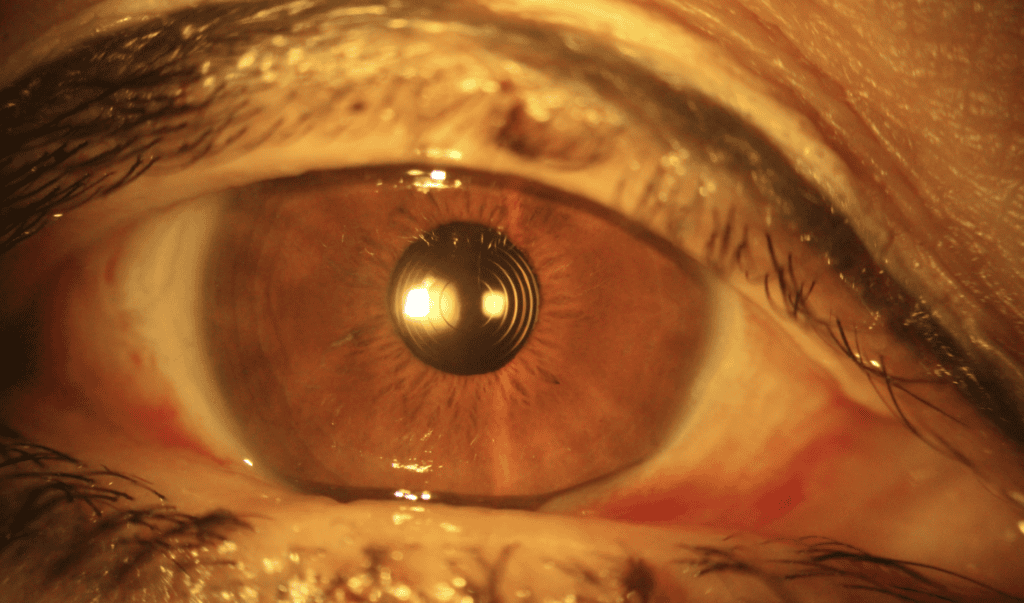 Ojo con lente intraocular